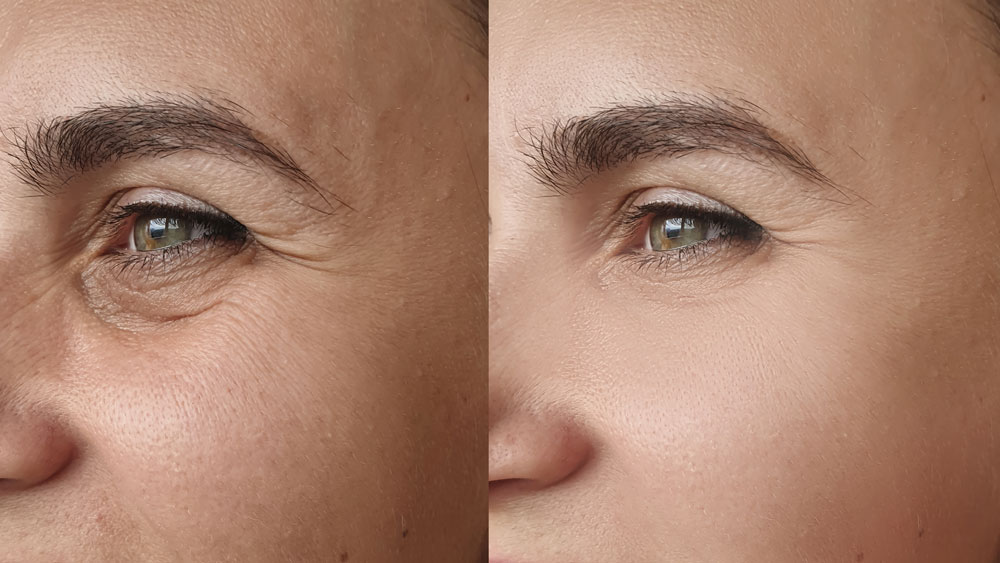 Read more about the article Everything You Need To Know About Eye Bag Removal