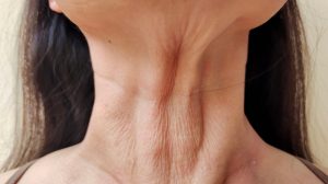 Read more about the article The Ultimate Guide To Neck Thread Lifts