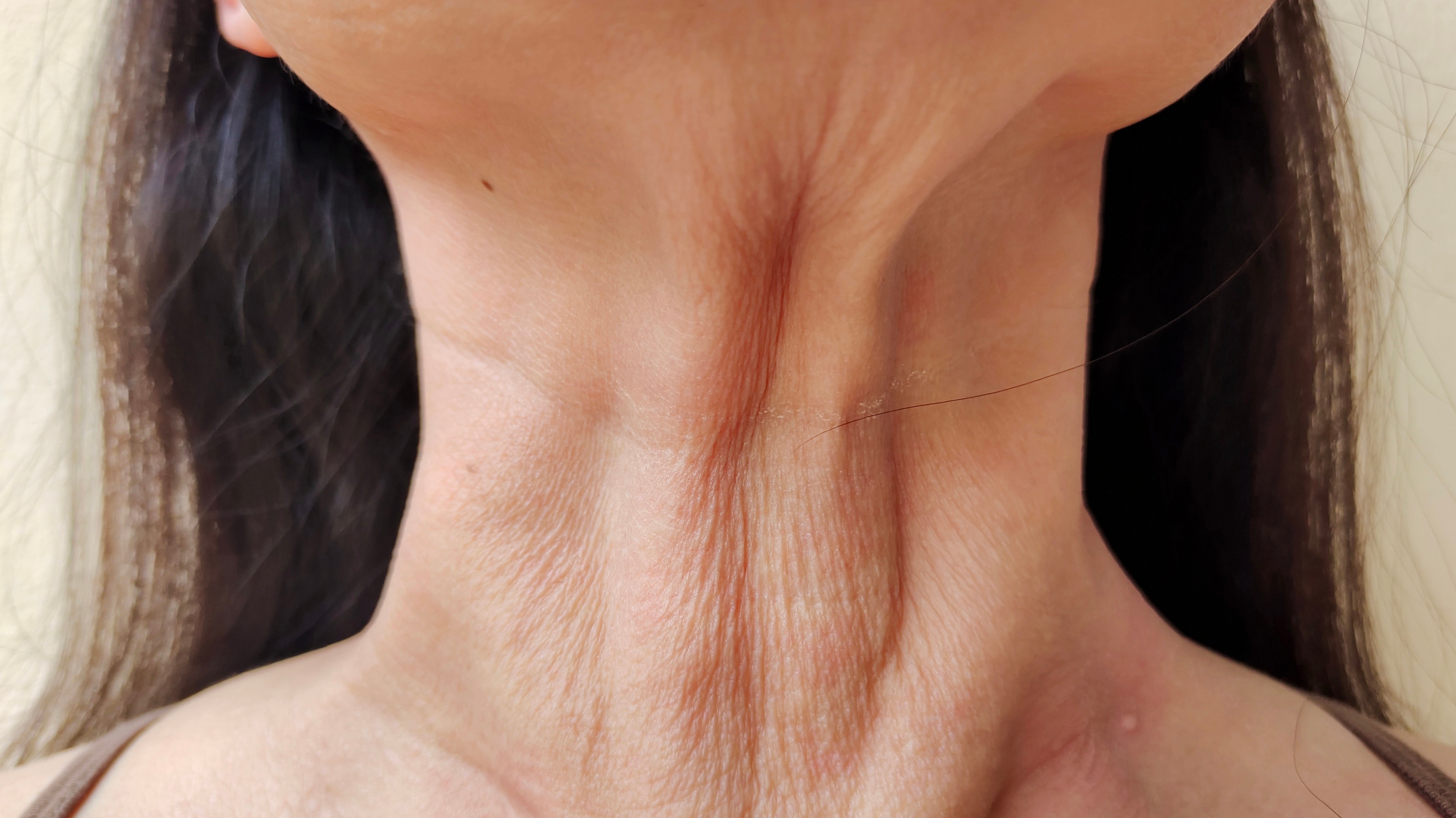 Read more about the article The Ultimate Guide To Neck Thread Lifts