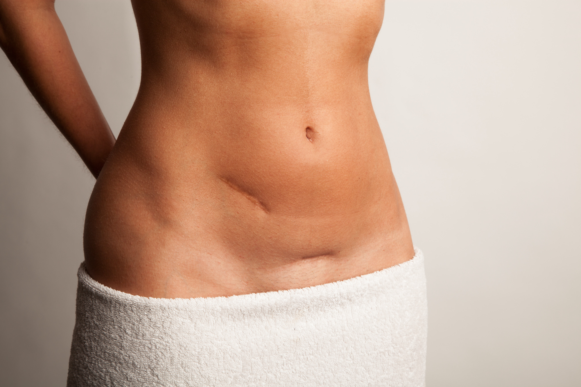 Read more about the article What is Scar Revision Surgery?