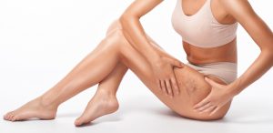 Read more about the article How to Prevent Spider Veins – The Ultimate Guide & Expert Tips