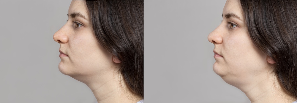 Read more about the article How to get rid of double chin after weight loss