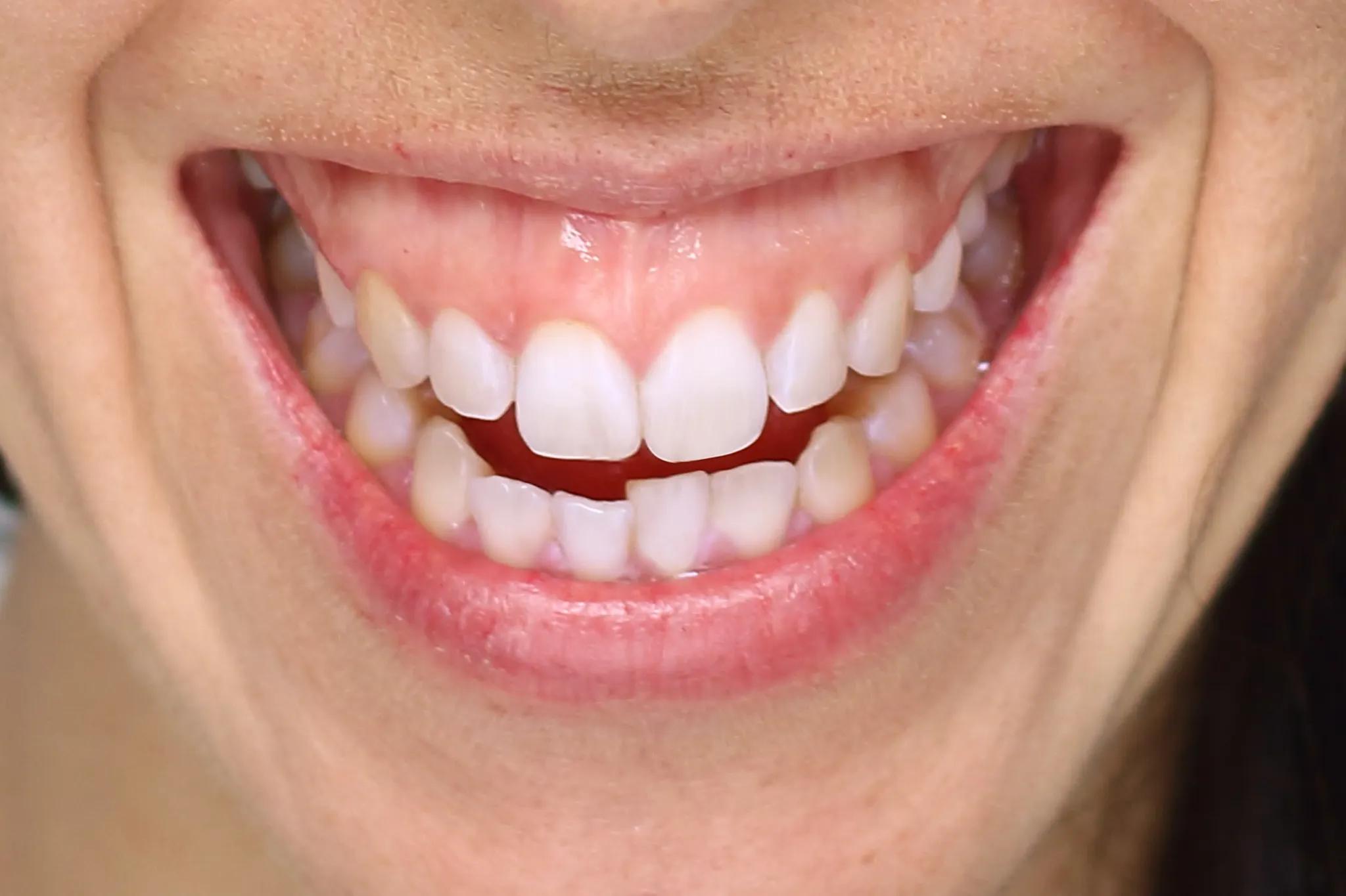 Read more about the article How to Fix a Gummy Smile? Best Treatments Explained