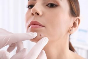 Read more about the article Mole Removal on Face: Safe Methods, Scarring & Regrowth Tips
