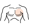 Mini-liposuction