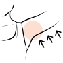 Miniarms Liposuction