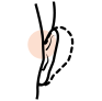 Otoplasty